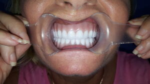 dentista dentadura cancun