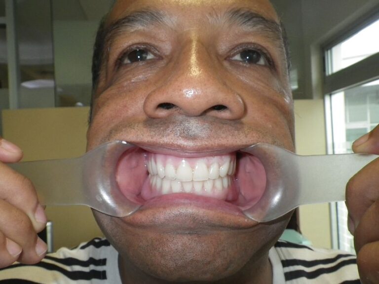 dentista dentadura cancun