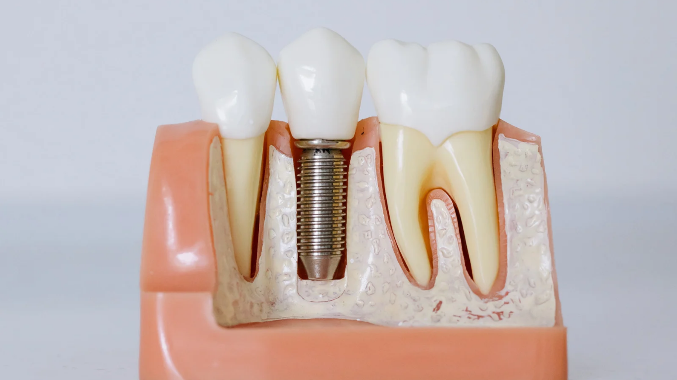¿Qué comer después de colocar implantes dentales?