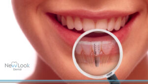 Todo lo que no te has atrevido a preguntar sobre los implantes dentales