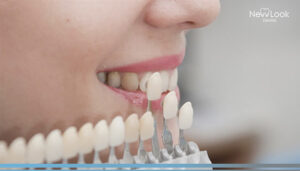 Mejora la apariencia de tus dientes con las carillas dentales
