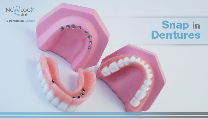 Snap in Dentures: La mejor solución para fijar tu dentadura.