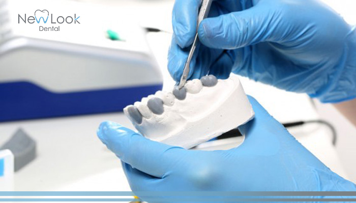 Qué es mejor ¿implante dental o puente fijo?