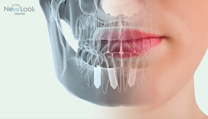El caso de éxito más longevo de implantes dentales.