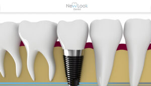 ¿Sabes qué sucede cuando no se cuidan adecuadamente los implantes dentales?