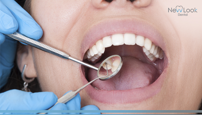 Caries dental: 8 datos que debes conocer