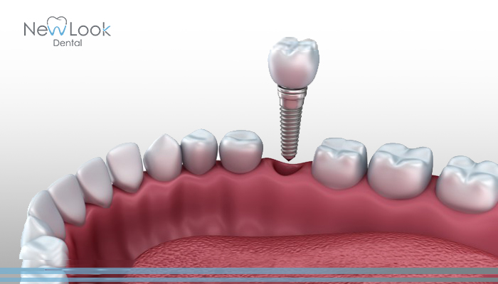 ¿Por qué fallan los implantes dentales?