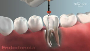 ¿Cambia la coloración de los dientes después de una endodoncia?