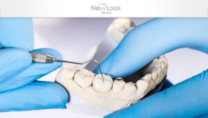 Implantes dentales, la mejor solución a la dentadura postiza