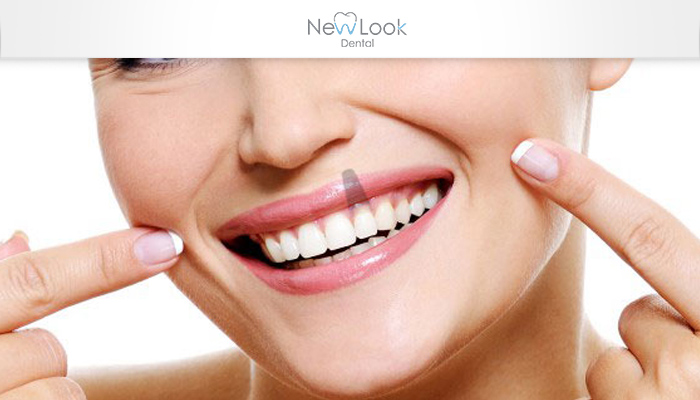 Los implantes dentales ayudan a mejorar tu calidad de vida