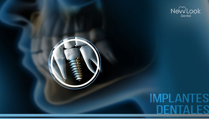 ¿Qué son los implantes dentales y cuáles son sus beneficios?