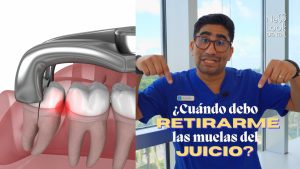 NLD_TERCEROSMOLARES_DrDavid_CuandoSacarmeLasMuelas_Thumb