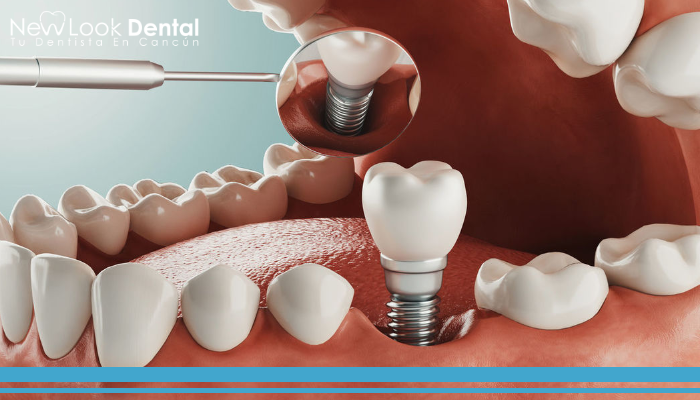 Osteointegración e Implantes Dentales