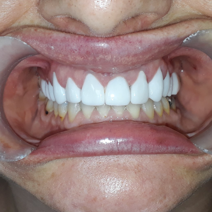 coronas dentales cosmetica dental cancun