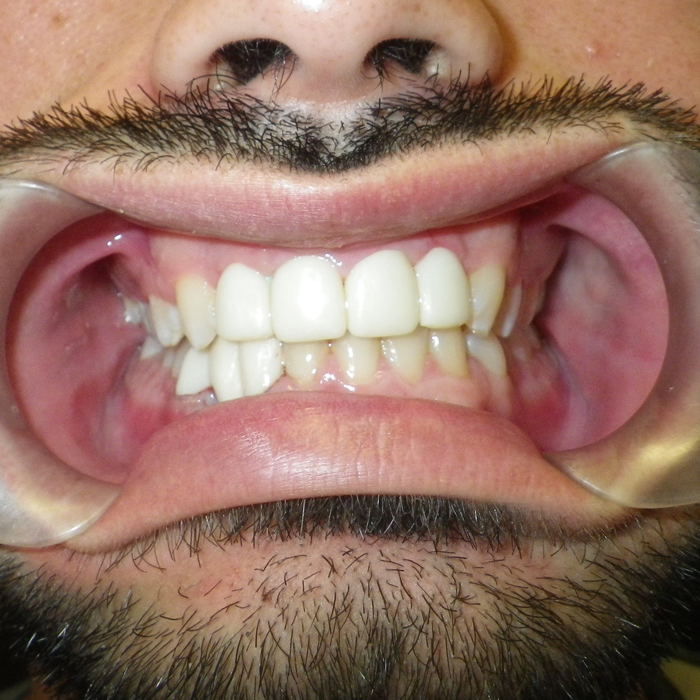 coronas dentales cosmetica dental cancun
