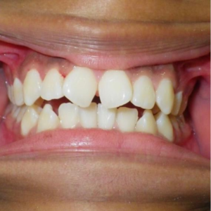 ortodoncia brackets cancun
