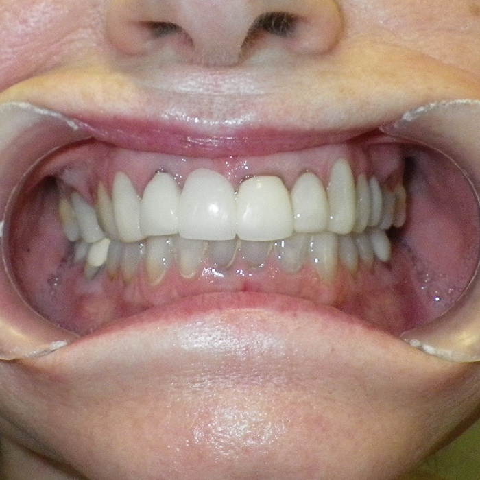 coronas dentales cancun
