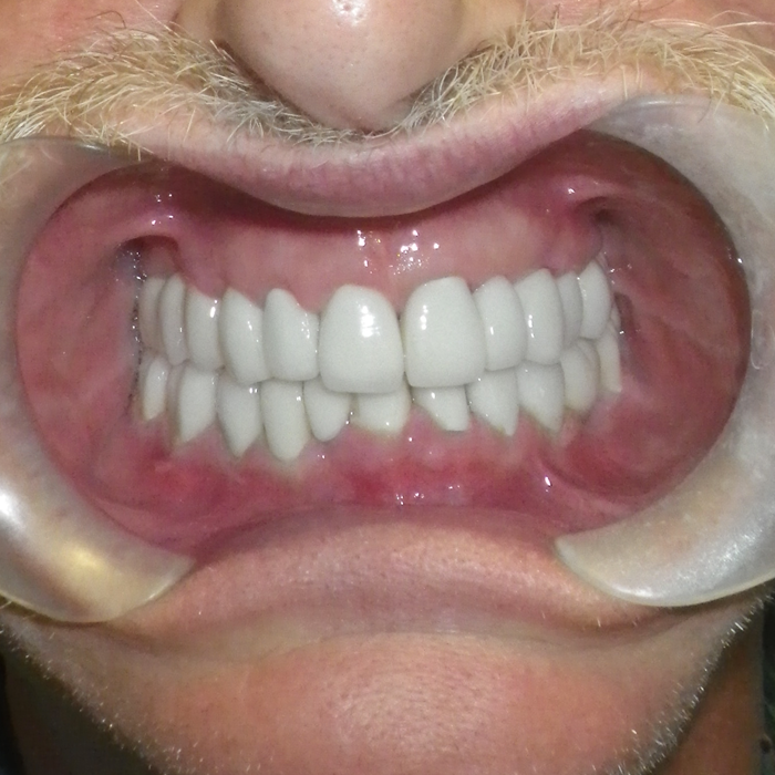 coronas dentales cancun