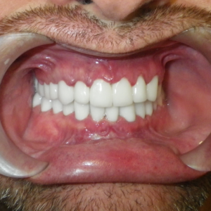 gingivectomia gingivoplastia coronas dentales cancun