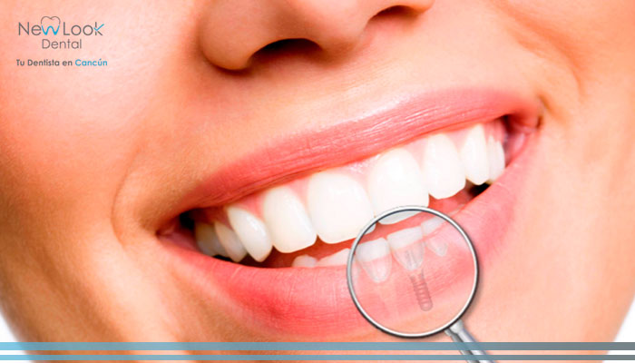 Mitos sobre implantes dentales
